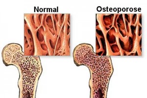 osteoporose-1