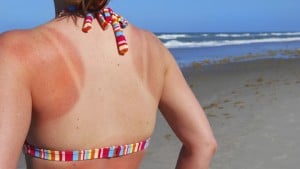sunburn-treatments-to-save-your-vacation-722x406